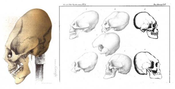 Elongated Skulls in utero: A Farewell to the Artificial Cranial Deformation Paradigm?