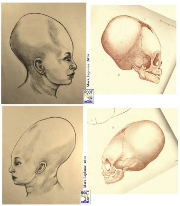 Elongated Skulls in utero: A Farewell to the Artificial Cranial Deformation Paradigm?